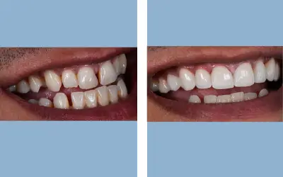Before and After